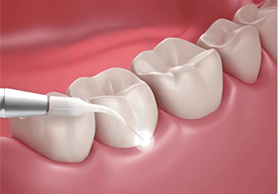 Bio-Lase Assisted Laser Procedures