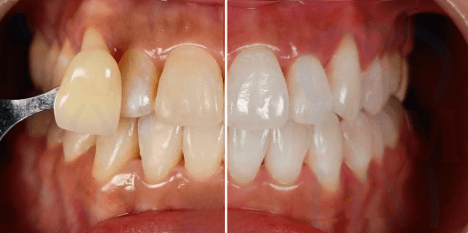 Teeth Whitening