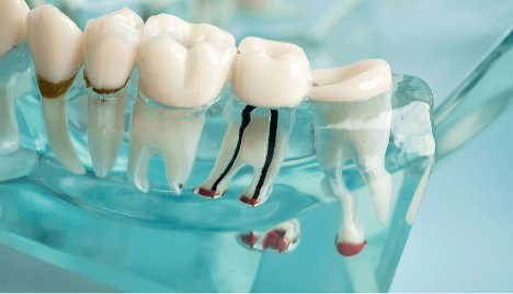 Root Canal Treatment